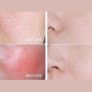 Dark Spot Correcting Brightening Cream before and after skin comparison showing reduced redness and even tone