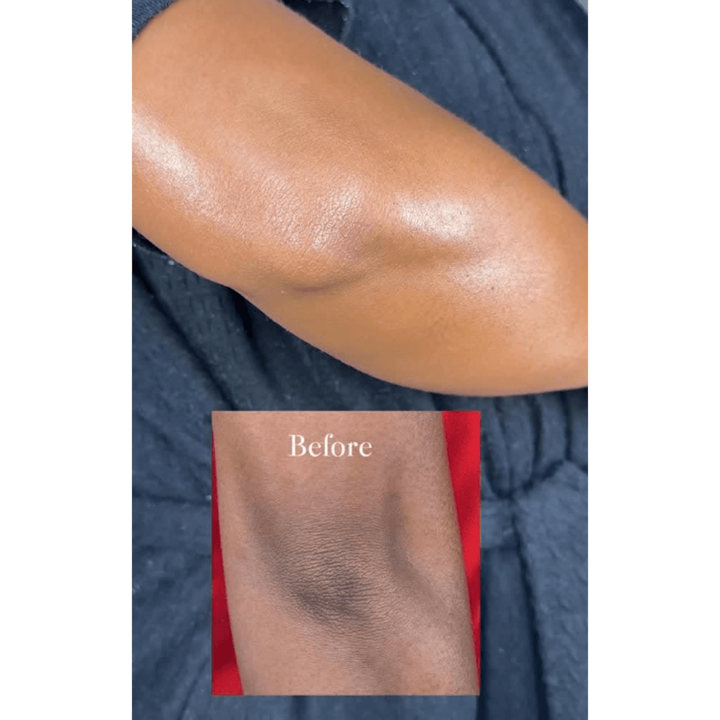 Before and after hyperpigmentation treatment on elbow