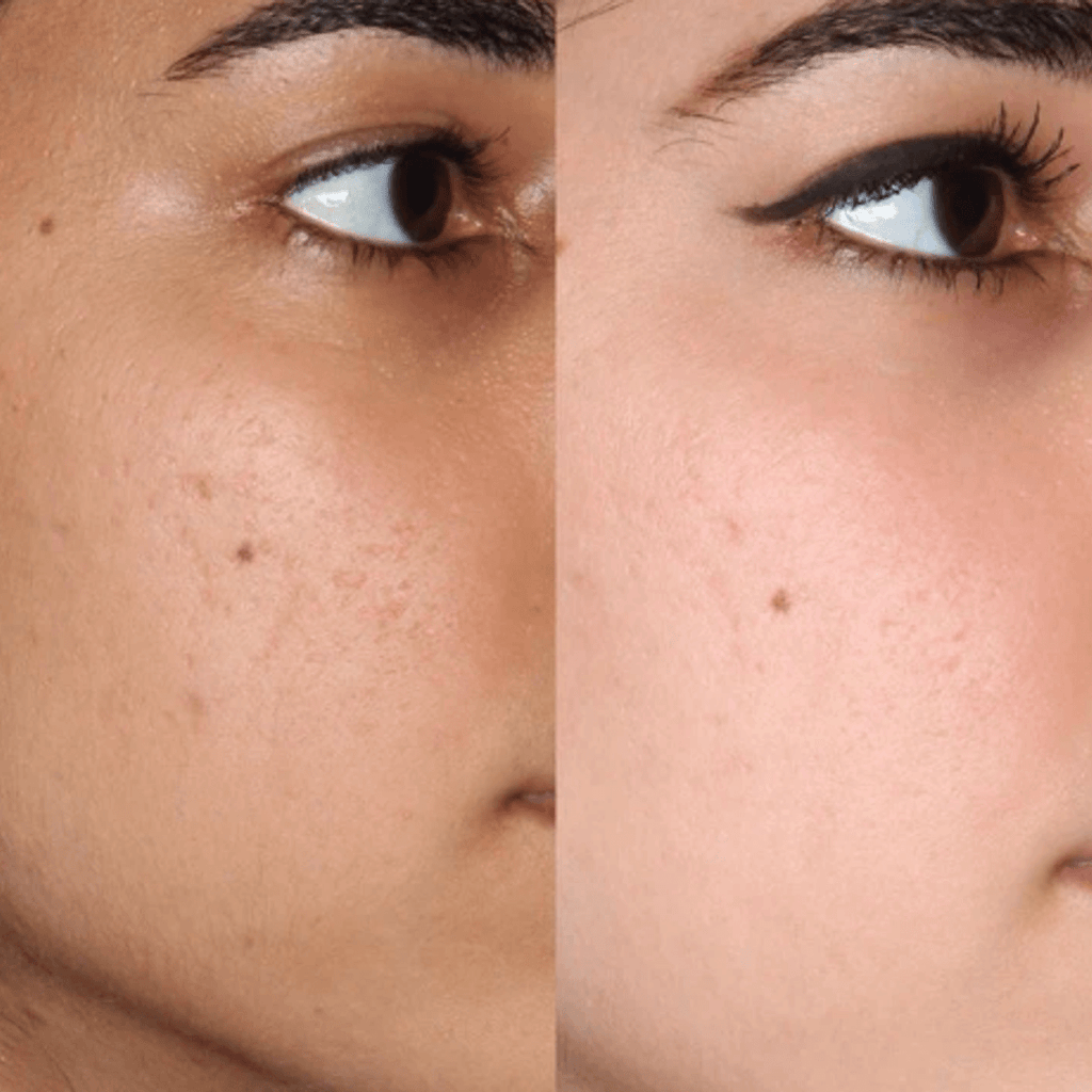 Before and after face brightening — 3 shades lighter