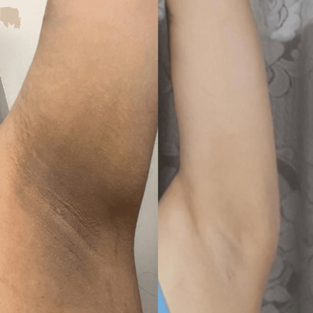 Before and after underarm brightening result
