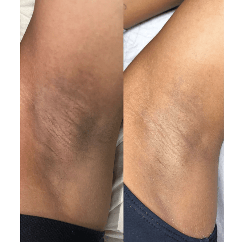 Before and after underarm skin brightening — visible results