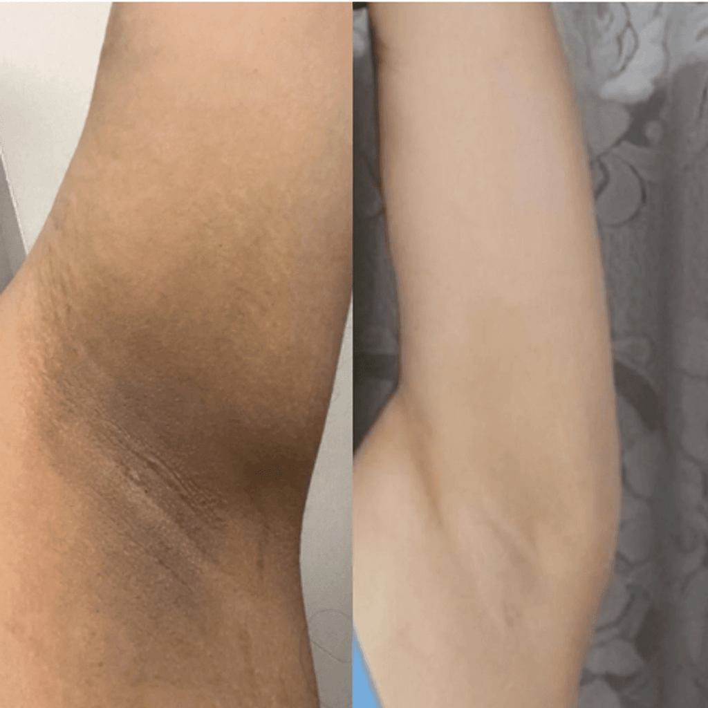Before and after skin brightening on elbow — 2 shades lighter