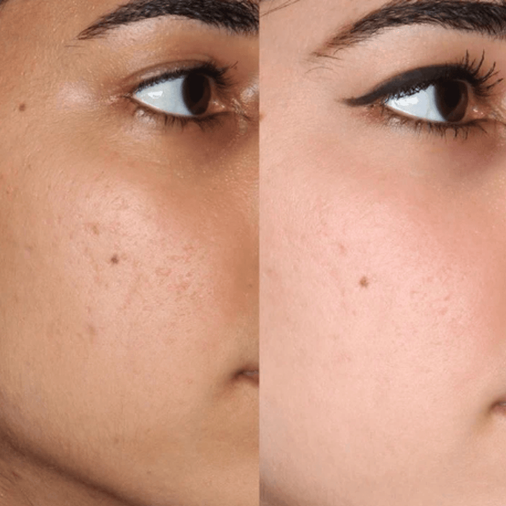 Before and after skin brightening on face — even skin tone