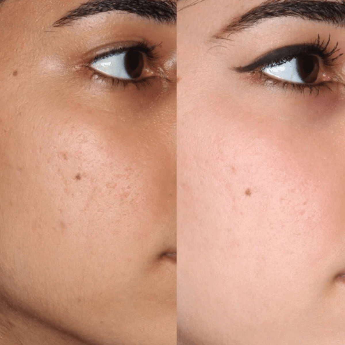 Before and after skin brightening on face — even skin tone