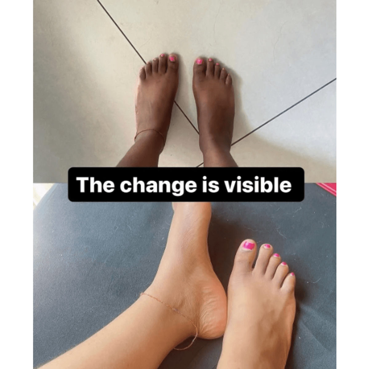 Before and after feet — visible skin brightening results