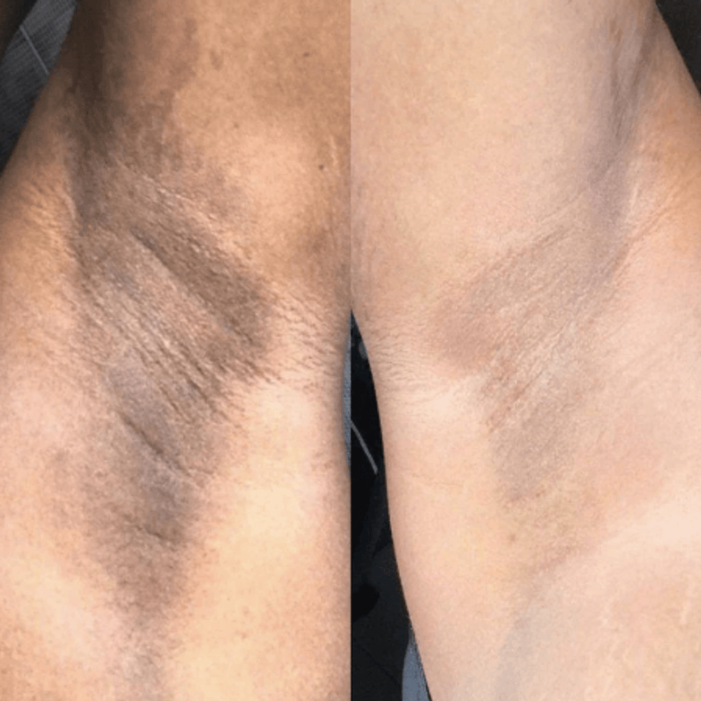 Before and after hyperpigmentation treatment on underarms