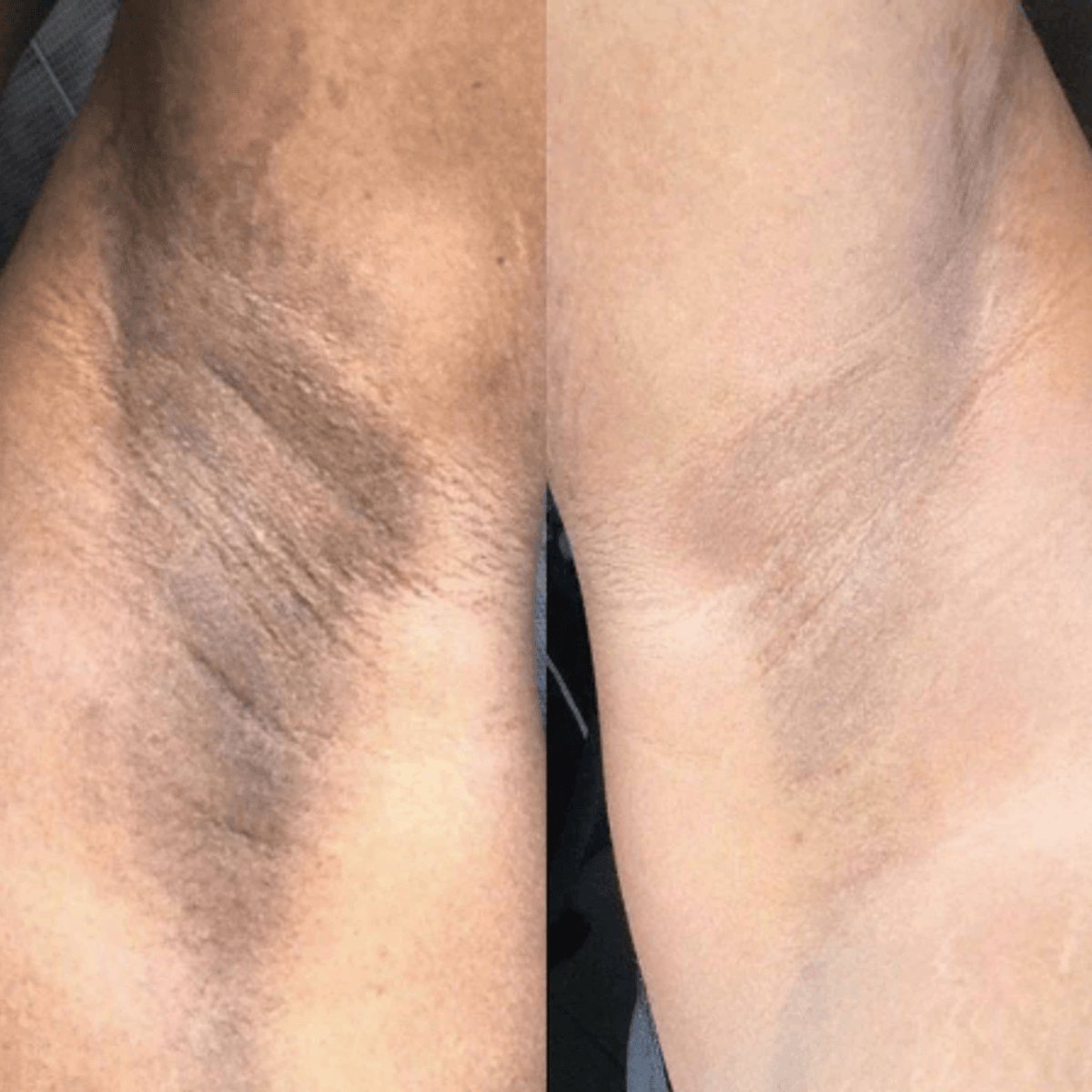 Before and after hyperpigmentation treatment on underarms